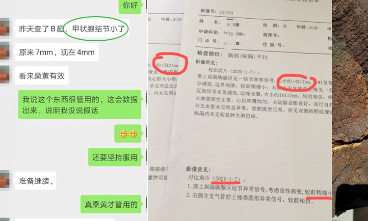 桑黃能治甲狀腺結節案例 桑黃能治甲狀腺結節案例